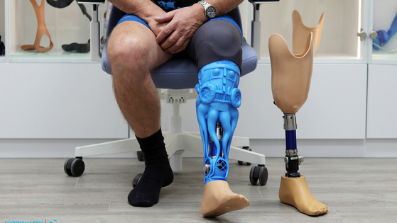 Creating a one-of-a-kind prosthesis with Artec Eva and Geomagic Freeform